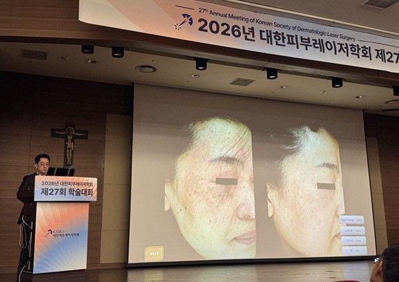 기미와 함께 숨어있는 ‘어브놈(ABNOM)’…초기 정확한 진단 관건
