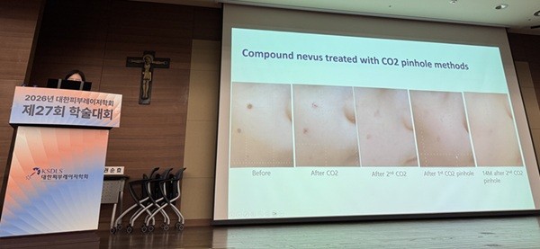 몽고반점? 밀크커피반점? 소아 색소질환도 '맞춤치료'해야